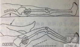 脑膜刺激征检查视频,直观解析临床诊断技巧